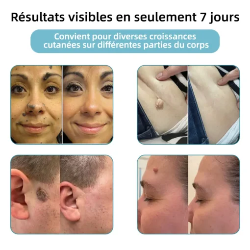𝐤𝐢𝐝𝐬𝐧𝐞𝐞𝐝® 𝐆𝐫𝐚𝐢𝐧𝐬 𝐝𝐞 𝐛𝐞𝐚𝐮𝐭é 𝐞𝐭 𝐯𝐞𝐫𝐫𝐮𝐞𝐬 𝐧𝐨𝐧 𝐢𝐧𝐯𝐚𝐬𝐢𝐟𝐬 𝐒𝐭𝐲𝐥𝐨 𝐥𝐚𝐬𝐞𝐫 𝐝'é𝐥𝐢𝐦𝐢𝐧𝐚𝐭𝐢𝐨𝐧