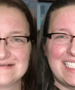 Custom-Fit Functional Dentures