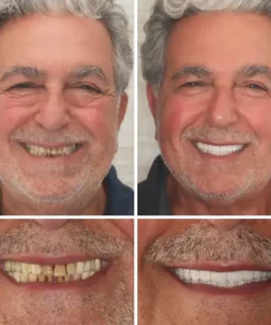 Custom-Fit Functional Dentures