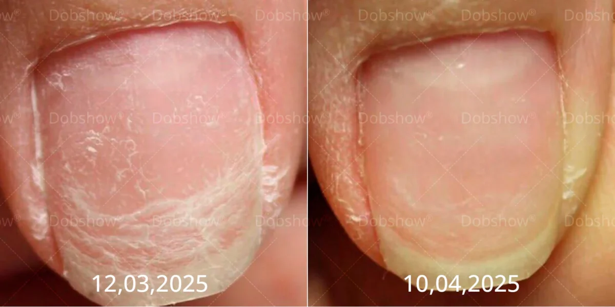 Cvreoz® Bee Venom Nail fungus care solution ：Natural Formula for Toenail & Fingernail Care