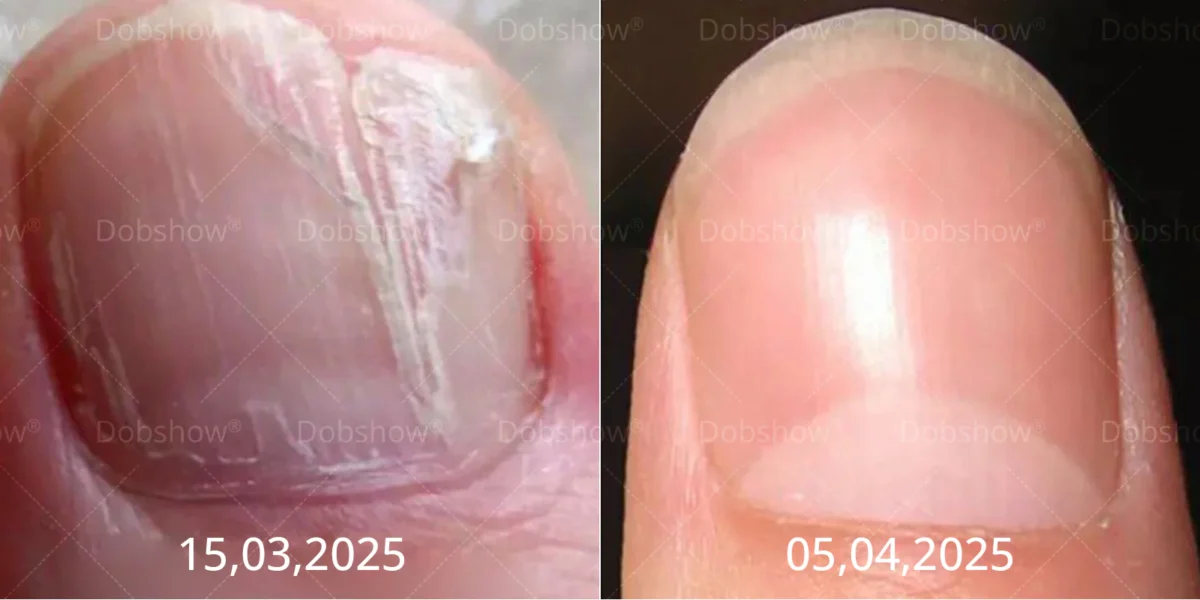 Cvreoz® Bee Venom Nail fungus care solution ：Natural Formula for Toenail & Fingernail Care