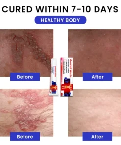 LIMETOW® Genital Warts Remover Cream