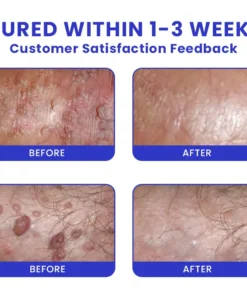 LIMETOW® Genital Warts Remover Cream