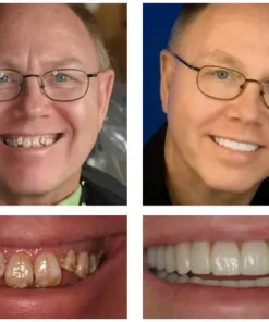 NESLEMY™ Custom-Fit Functional Dentures