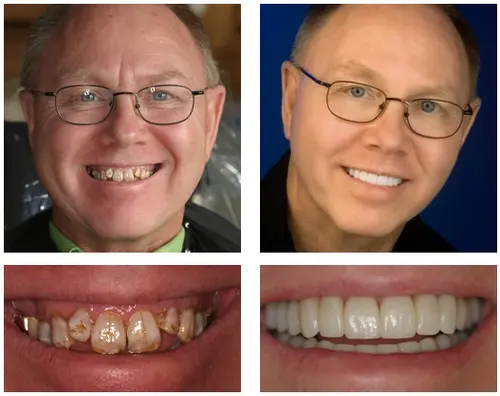 NESLEMY™ Custom-Fit Functional Dentures