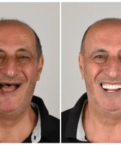 NESLEMY™ Custom-Fit Functional Dentures