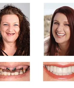 NESLEMY™ Custom-Fit Functional Dentures