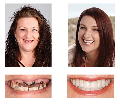 NESLEMY™ Custom-Fit Functional Dentures