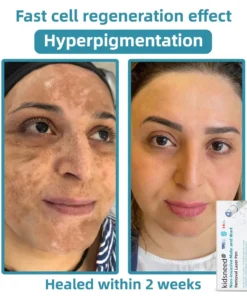 Remifa® Non-invasive Mole & Wart Removal Laser Pen