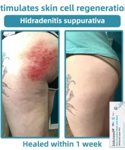 Remifa® Non-invasive Mole & Wart Removal Laser Pen