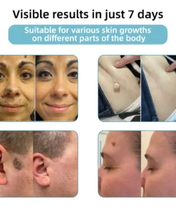 Remifa® Non-invasive Mole & Wart Removal Laser Pen