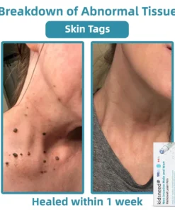 Remifa® Non-invasive Mole & Wart Removal Laser Pen