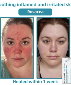 Remifa® Non-invasive Mole & Wart Removal Laser Pen