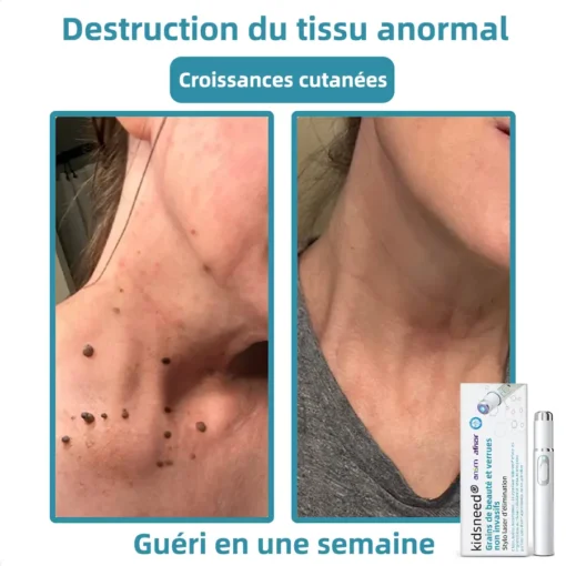 kidsneed® Grains de beauté dan verrues non invasif Stylo laser d'élimination
