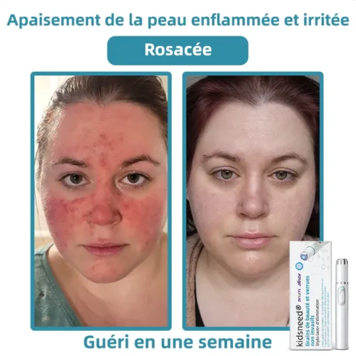 kidsneed® Grains de beauté dan verrues non invasif Stylo laser d'élimination