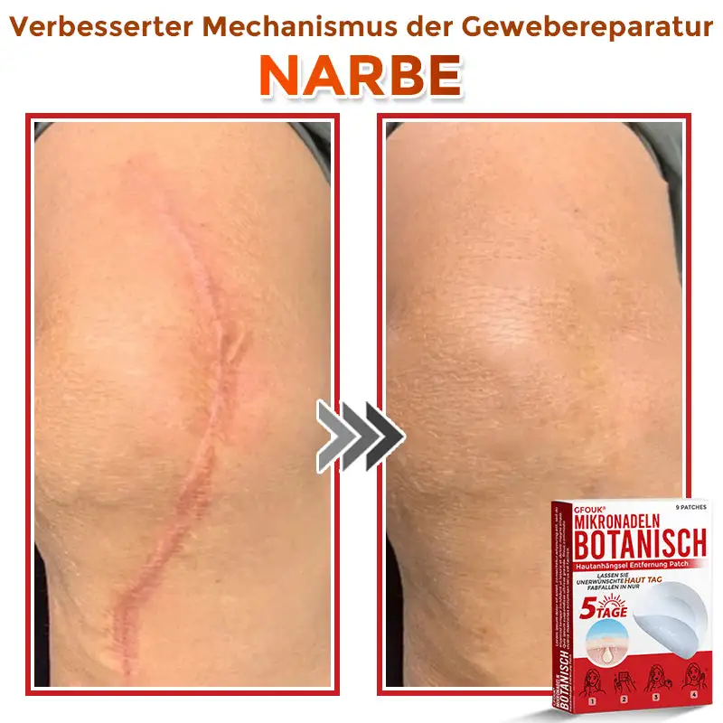 GFOUK® Mikronadeln Botanisch Hautanhängsel Entfernung Patch