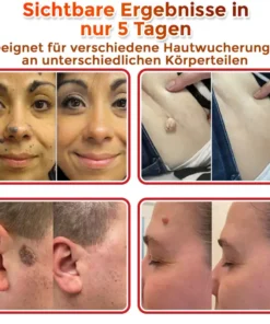 GFOUK® Mikronadeln Botanisch Hautanhängsel Entfernung Patch