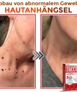 GFOUK® Mikronadeln Botanisch Hautanhängsel Entfernung Patch