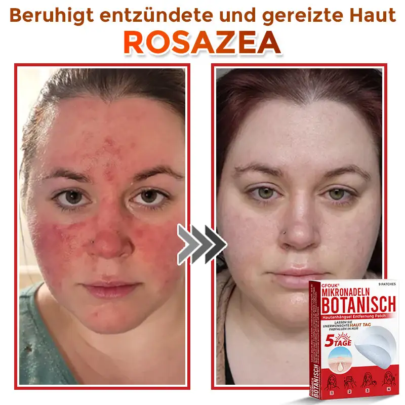 GFOUK® Mikronadeln Botanisch Hautanhängsel Entfernung Patch