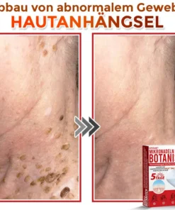 GFOUK® Mikronadeln Botanisch Hautanhängsel Entfernung Patch