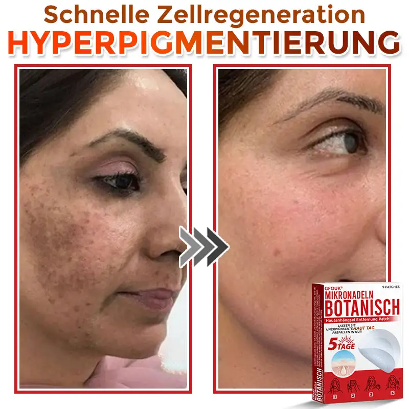 GFOUK® Mikronadeln Botanisch Hautanhängsel Entfernung Patch