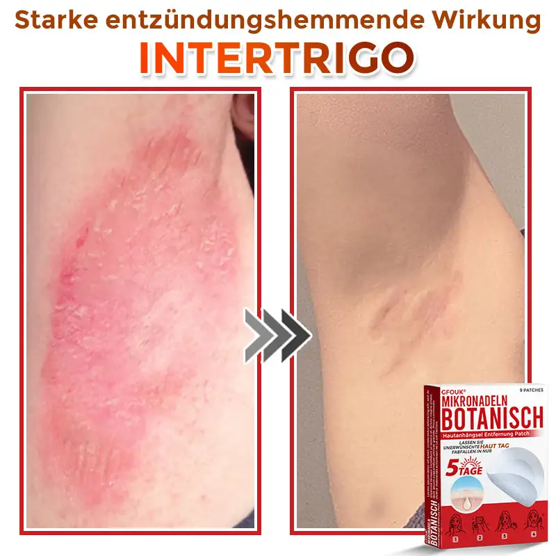GFOUK® Mikronadeln Botanisch Hautanhängsel Entfernung Patch