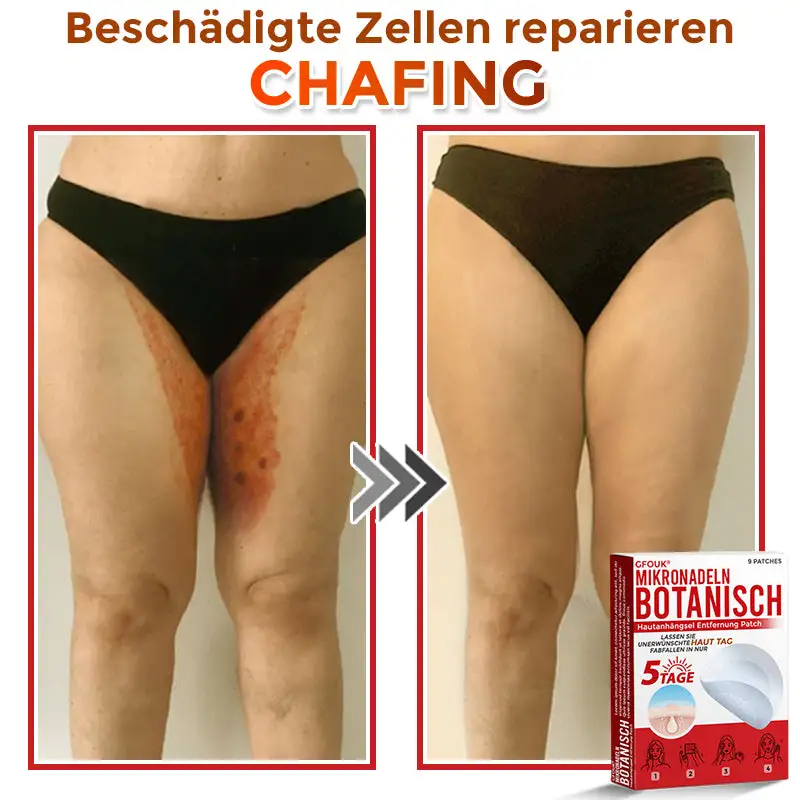 GFOUK® Mikronadeln Botanisch Hautanhängsel Entfernung Patch