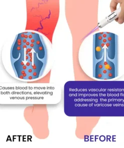 🌟 Official Store | Bikenda® Varicose Vein Photothermal Laser Treatment🔥Say Goodbye to Varicose Veins and Hello to Confidence!