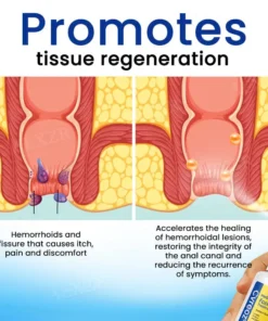 Cvreoz® Herbal Hemorrhoids Fast-Acting Treatment Spray