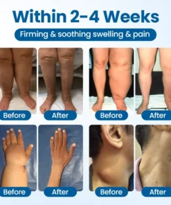 Timilk® Lymphora Wiwu Relief Roll-Lori