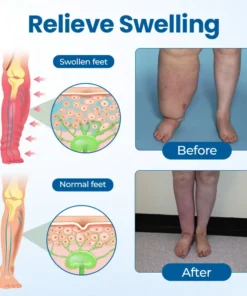 Timilk® Lymphora Wiwu Relief Roll-Lori