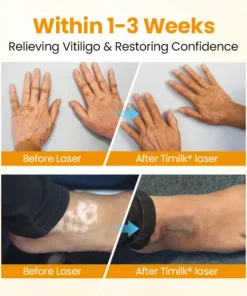 Chwistrell Cyflym Timilk® VitiGone — Ail-bigmentiad 2–3 Wythnos gydag OTDS