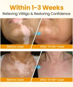 Chwistrell Cyflym Timilk® VitiGone — Ail-bigmentiad 2–3 Wythnos gydag OTDS