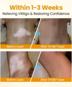 Chwistrell Cyflym Timilk® VitiGone — Ail-bigmentiad 2–3 Wythnos gydag OTDS