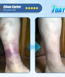 ADFIRE® Diabetic Skin Revolution