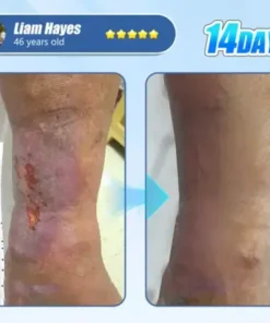 ADFIRE® Diabetic Skin Revolution