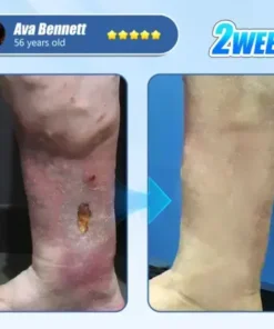 ADFIRE® Diabetic Skin Revolution