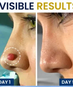 AEXZR® Skin Tag Cryo Treatment Spray