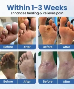 Biancat® VenHeal Bee Venom Diabetic Wound Spray