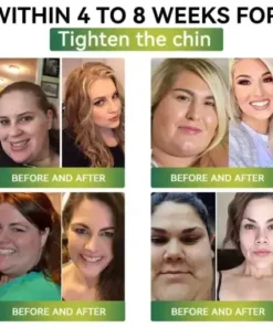 Buildleaf® SMGT-GLP-1 Nano Microneedle Patch with Collagen Peptides &Matrixyl 3000