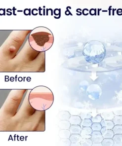 Cvreoz® WartFreez Cryo Wart Removal Spray