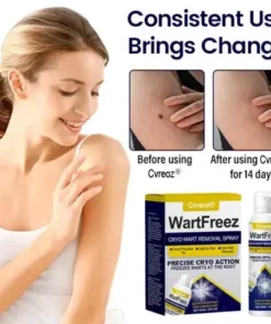 Cvreoz® WartFreez Cryo Wart Removal Spray