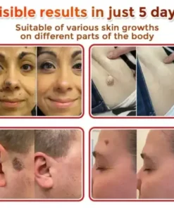 Juxek™ Removal Patch: Gentle Microneedle Patches for Skin Tag & Mole Removal