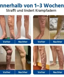 Oveallgo® 𝐕𝐞𝐢𝐧𝐓𝐚𝐫𝐠𝐞𝐭 𝐌𝐢𝐜𝐫𝐨𝐧𝐞𝐞𝐝𝐥𝐞 𝐏𝐚𝐭𝐜𝐡