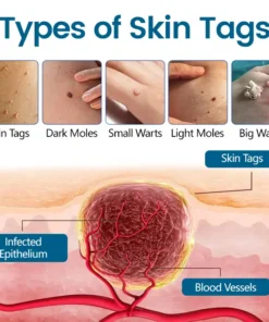 Timilk® DermaVenom RX+ Precision Removal Cream