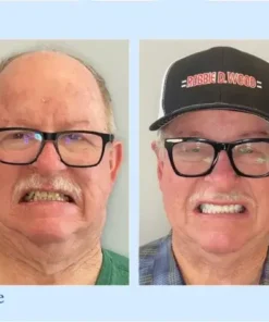 NESLEMY™ Custom-Fit Functional Dentures – Perfectly Fitted in Minutes at Home