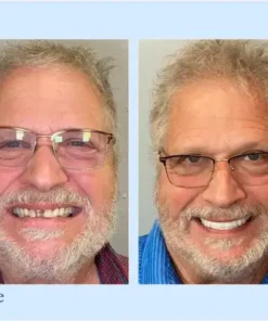 NESLEMY™ Custom-Fit Functional Dentures – Perfectly Fitted in Minutes at Home